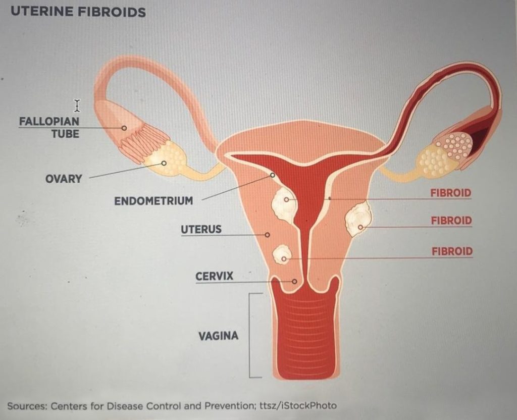 Uterine Fibroid Treatment Center, Corona, California. Avoid a hysterectomy with Dr. Omar Saleh, founder of the Vein and Fibroid Treatment Center. 