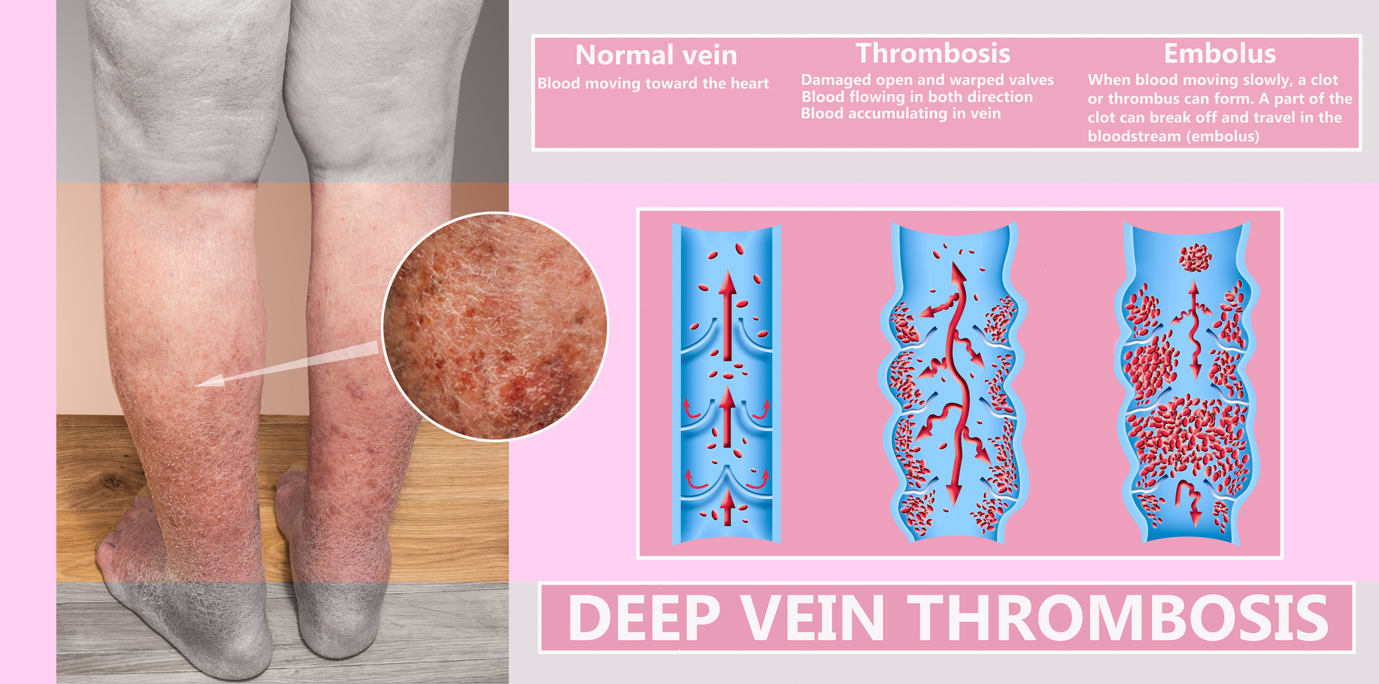 Deep Vein Thrombosis Treatment Center Corona, California